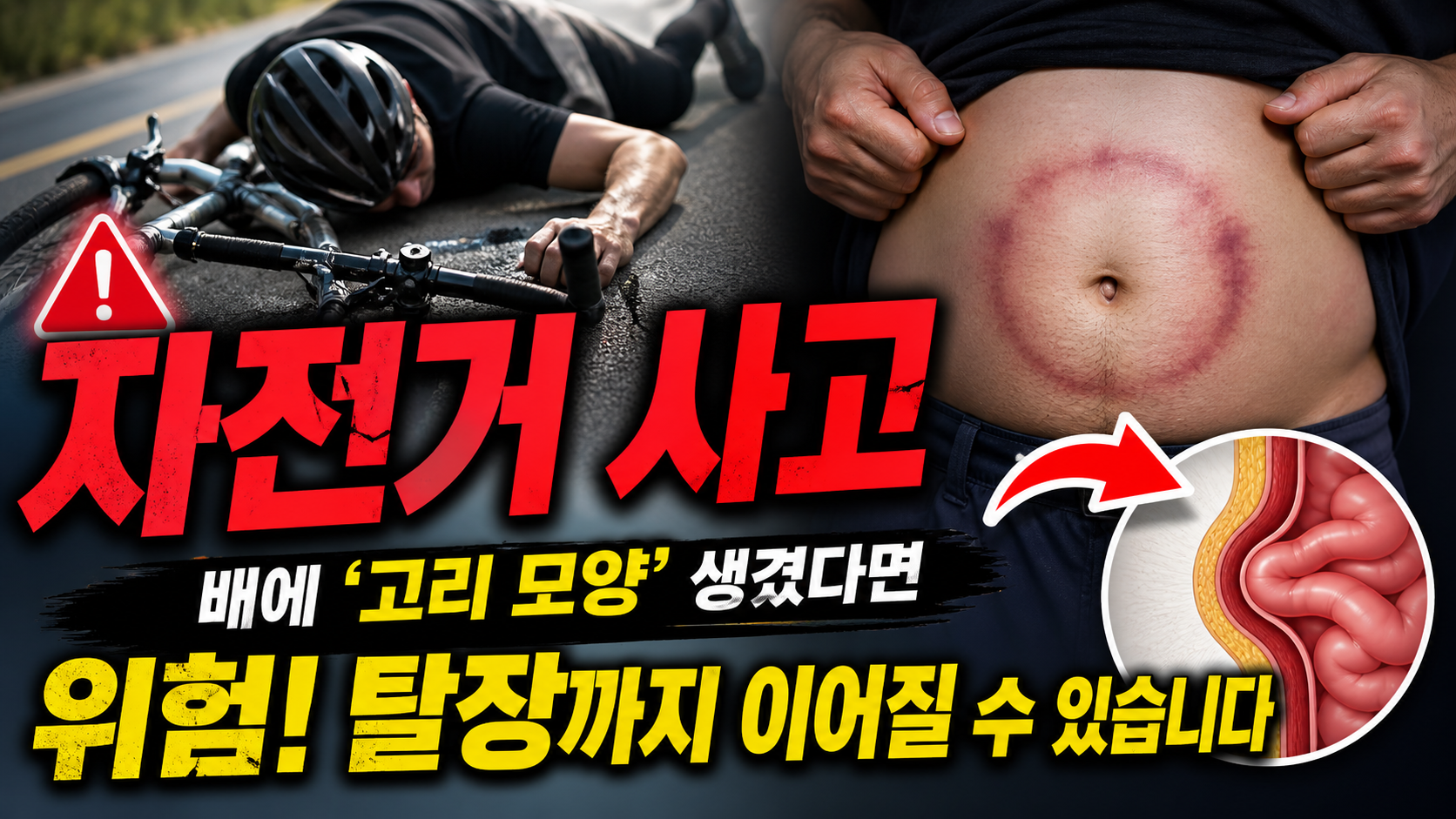 자전거 사고 후 배에 ‘고리 모양’ 생겼다면 위험…탈장까지 이어지는